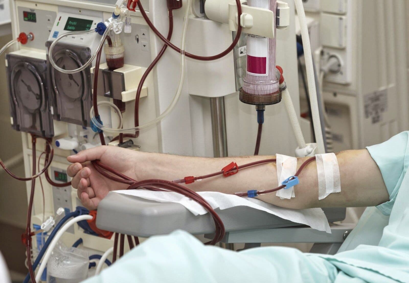 Pacientes renais denunciam contaminação em hemodiálises em JP