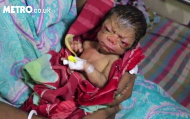 Bebê nasce com aparência de idoso e é comparado a "Benjamin Button"