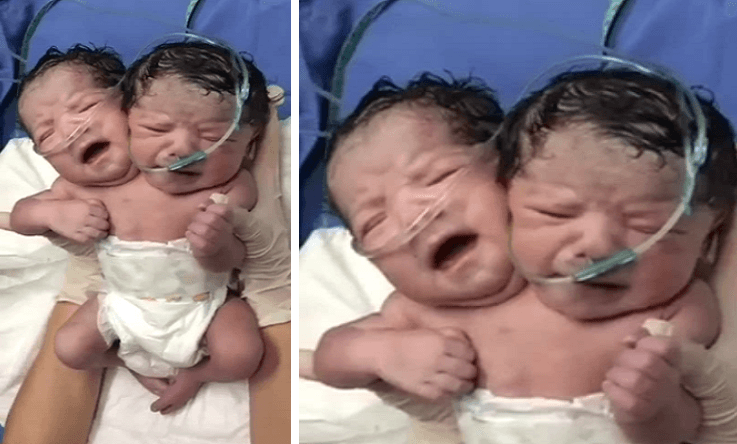 Morre bebê que nasceu com duas cabeças no México