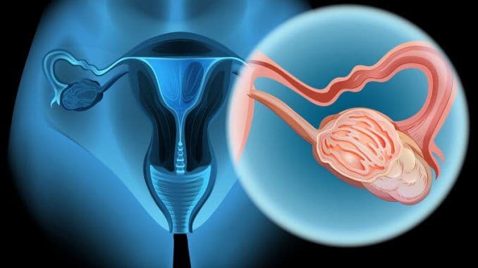 Cientistas descobrem molécula que poderá tratar câncer de ovário