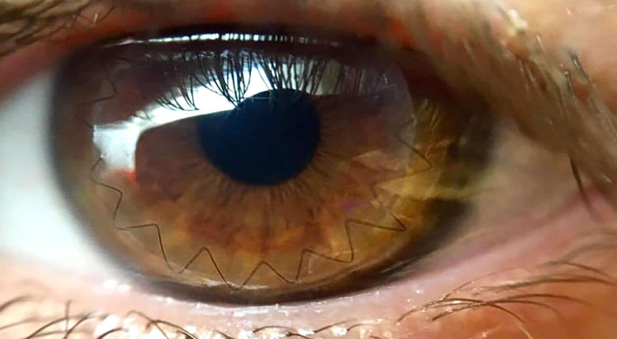 Paraíba retoma atividades para transplantes de córneas