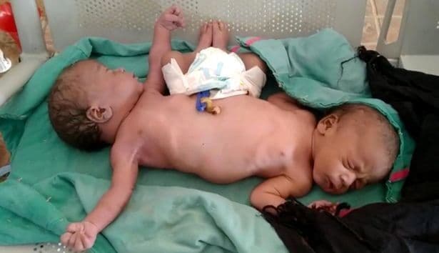 Gêmeas siamesas nascem com duas pernas e quatro braços e desafiam médicos