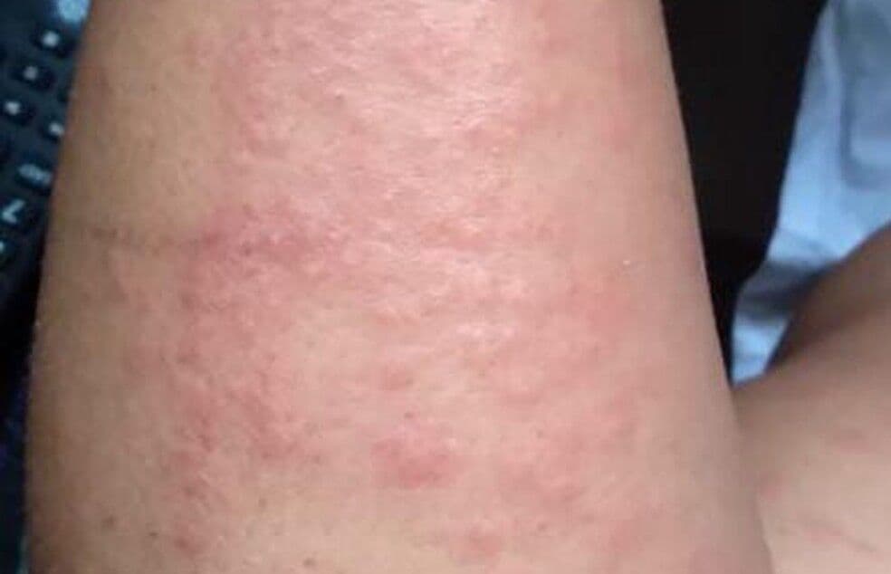 Surto de lesões na pele que causam coceira: saiba quais as possíveis causas que são investigadas no Grande Recife