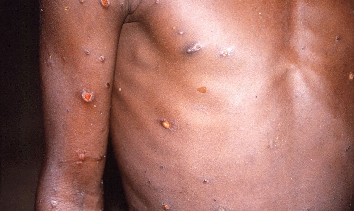 Casos suspeitos de Monkeypox crescem 34,28% em uma semana, na Paraíba