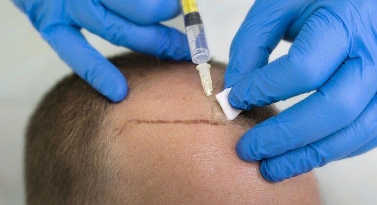 Queda de cabelo e calvície podem estar com os dias contados; entenda