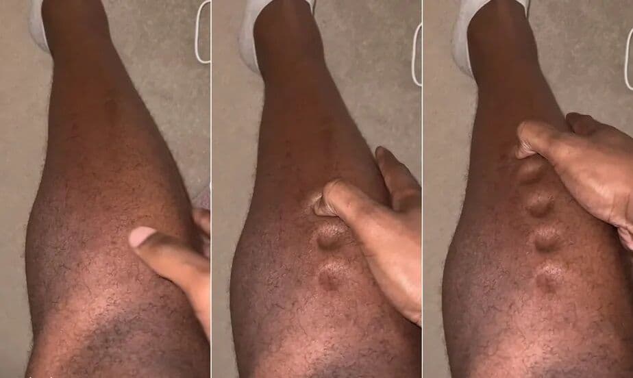 Atleta viraliza após perna parecer ‘massinha de modelar’ devido à infecção; veja vídeo