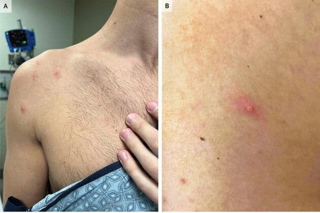OMS encerra emergência de saúde global da mpox