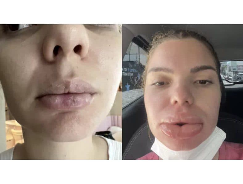 Médica orienta que consulta prévia é essencial para procedimentos estéticos; falta de cuidado pode resultar em necrose e até perda dos lábios