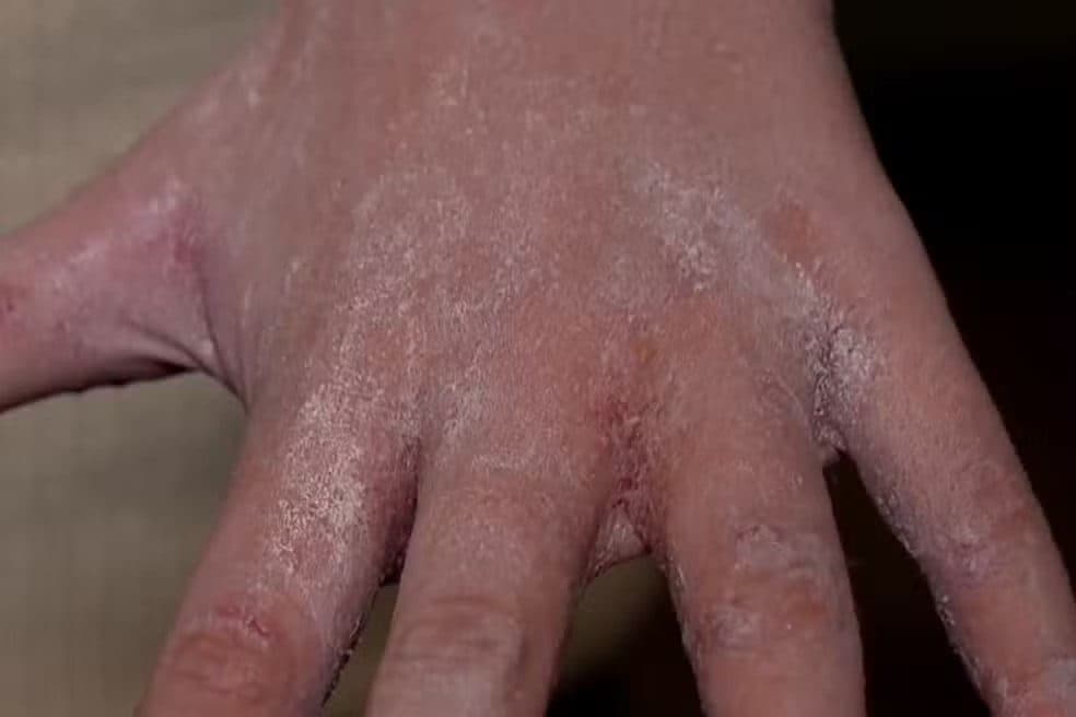 Filhos de cantor pegam sarna em escola com surto de casos