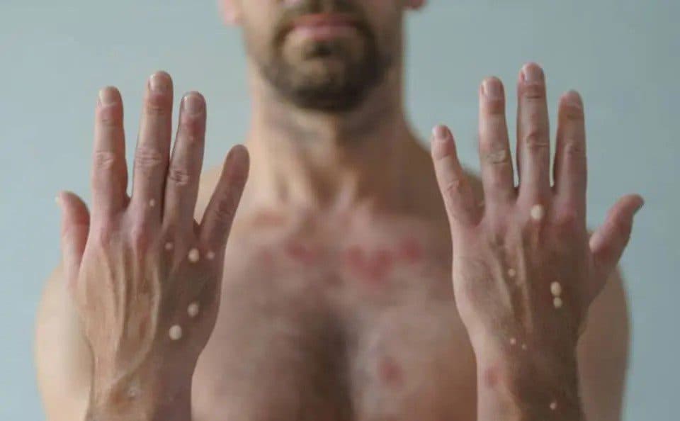 Governo de Pernambuco apura suspeita de caso de Mpox em escola de Paulista, no Grande Recife