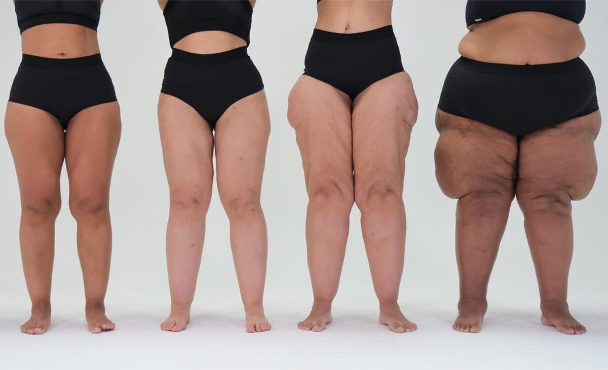 Estudo revela por que pacientes com lipedema têm dificuldade em ganhar massa muscular