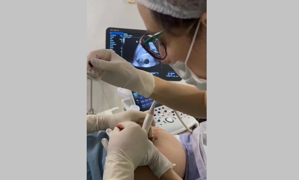 Procedimento raro: feto recebe transfusão de sangue antes do nascimento na Paraíba