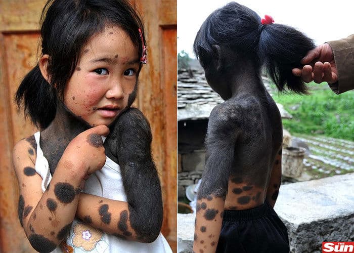 Garota de seis anos com "síndrome do lobisomem" é abandonada pelos pais