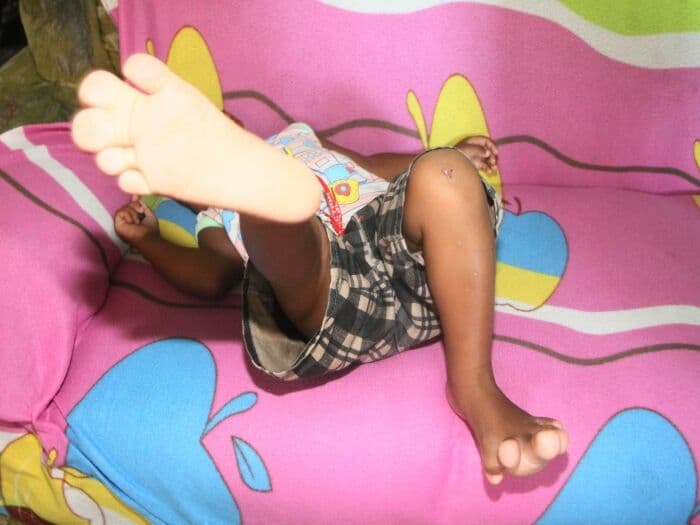 Pé gigante de menino não deve parar de crescer, diz endocrinologista