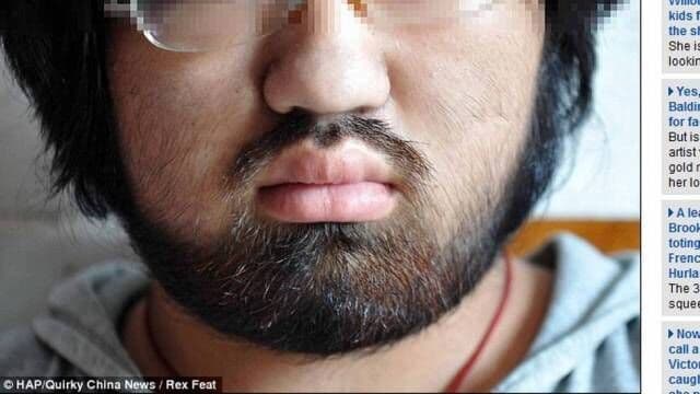 Tratamento faz chinesa ficar com barba