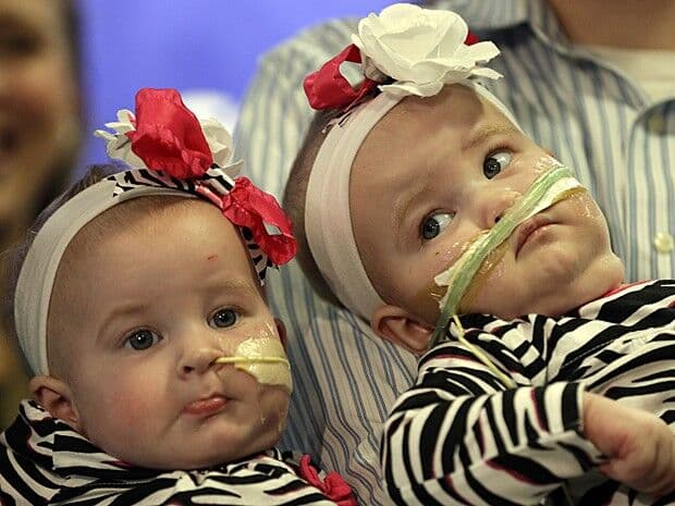 Gêmeas siamesas são separadas após 7h e se recuperam nos EUA
