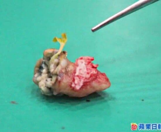 Semente de goiaba nasce dentro do dente cariado de um chinês