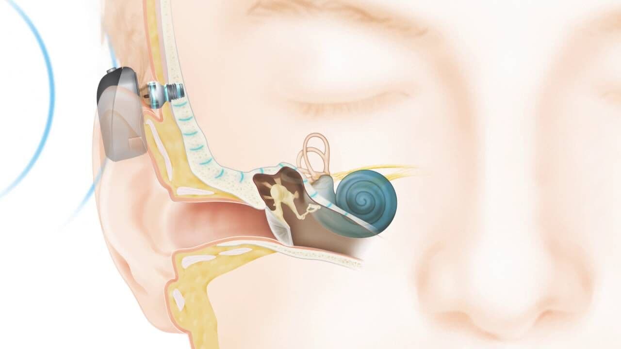 João Pessoa sedia oficina sobre implante do sistema Baha para deficientes auditivos