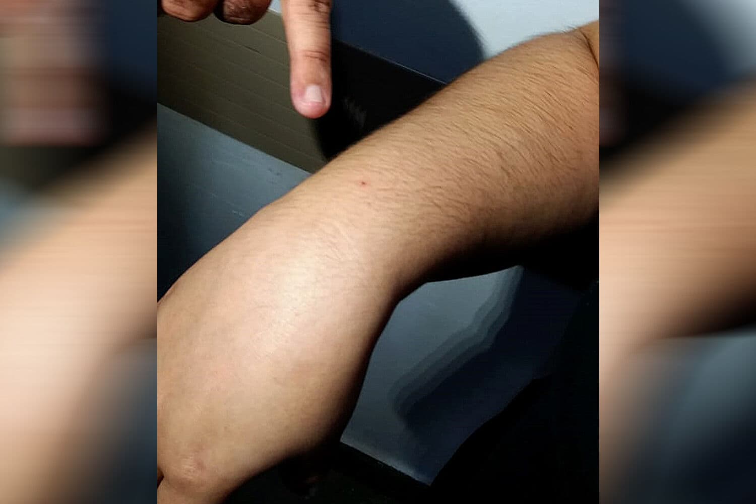 Sobe para 61 o número de pessoas que relatam ataques com agulhas no São João de CG