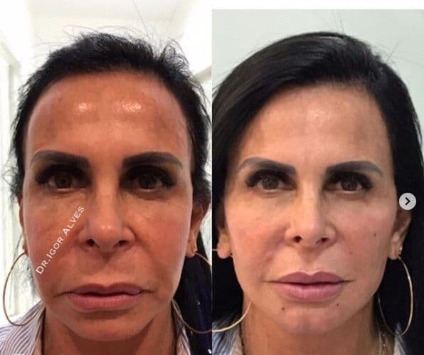 Gretchen faz ‘harmonização facial’ e choca internet com rosto renovado