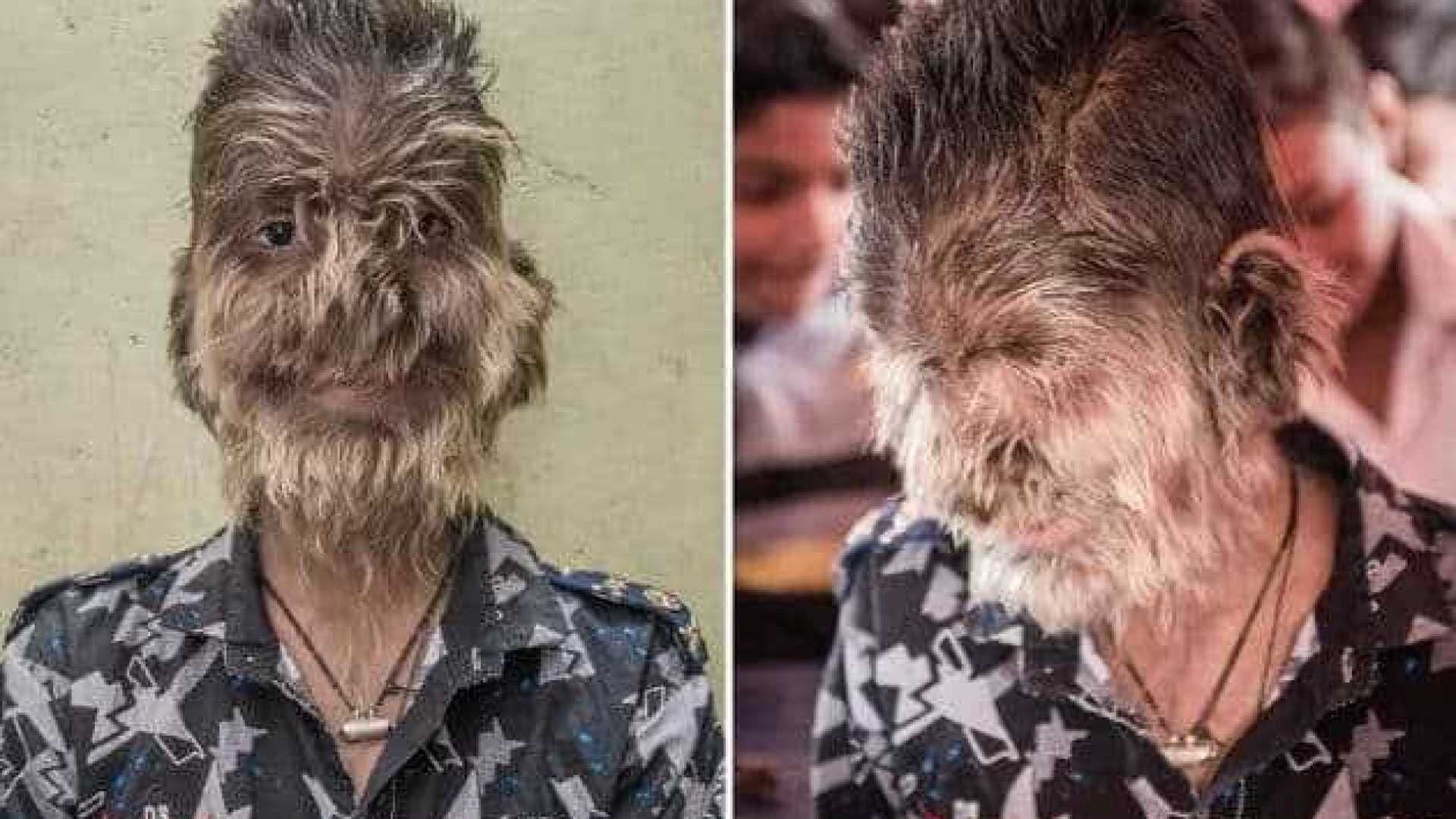 Menino indiano tem doença rara que deixa o rosto coberto de cabelo