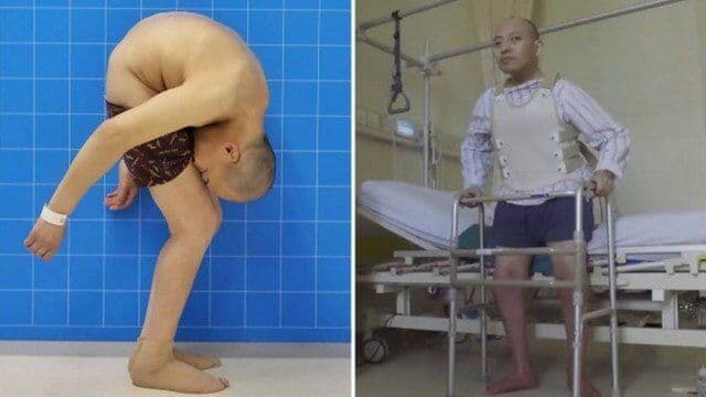 Paciente passa por cirurgia e fica com a coluna ereta após 28 anos