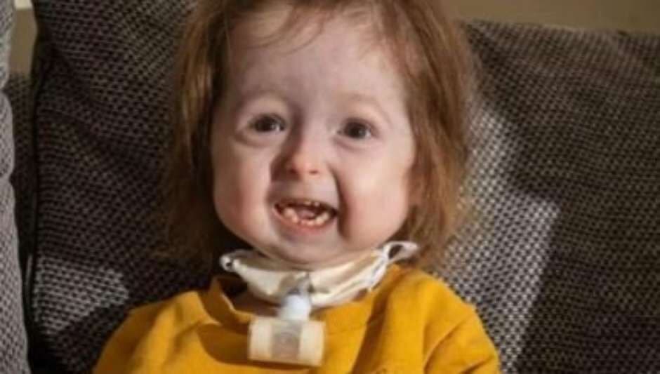 Bebê é única no mundo a possuir doença de Benjamin Button