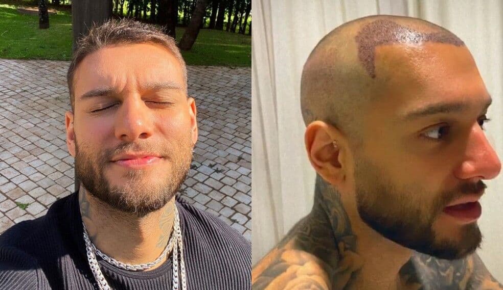 Cantor Lucas Lucco aparece careca nas redes sociais e revela que fez implante capilar