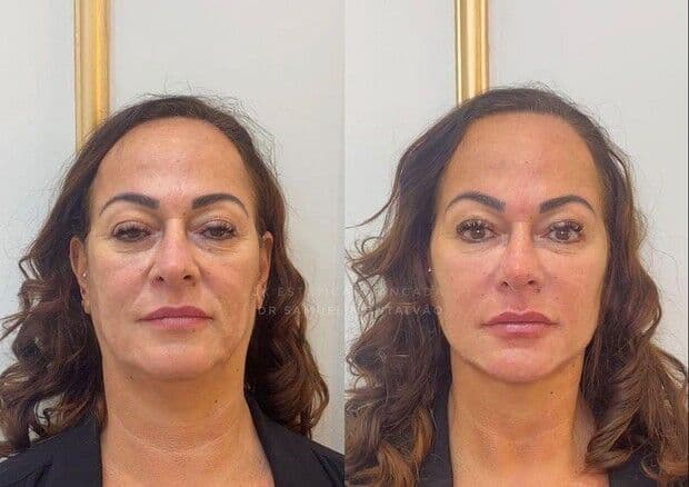 Mãe de Neymar passa por procedimento estético e mostra antes e depois