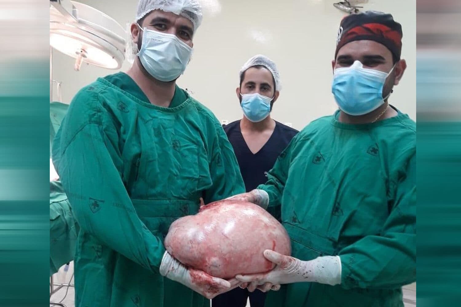 Tumor de quase 20 kg é retirado do ovário de paciente que pensava estar grávida