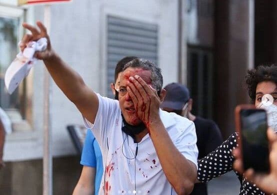 Homem perde visão de um olho após ser atingido por bala de borracha disparada em ato contra Bolsonaro no Recife