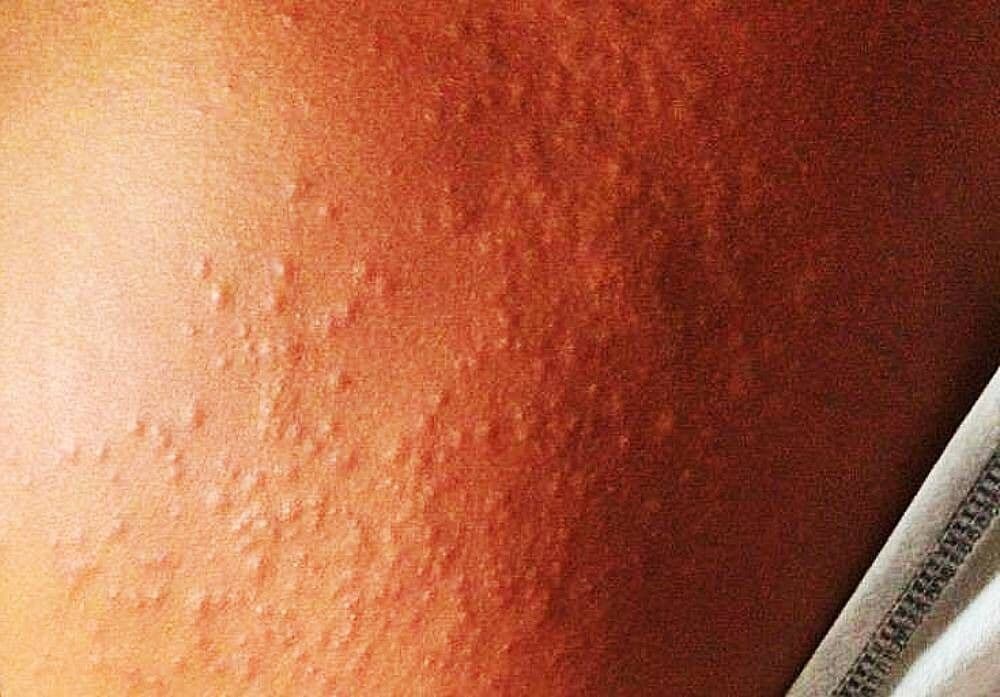 Surto de coceira misteriosa preocupa médicos no Grande Recife