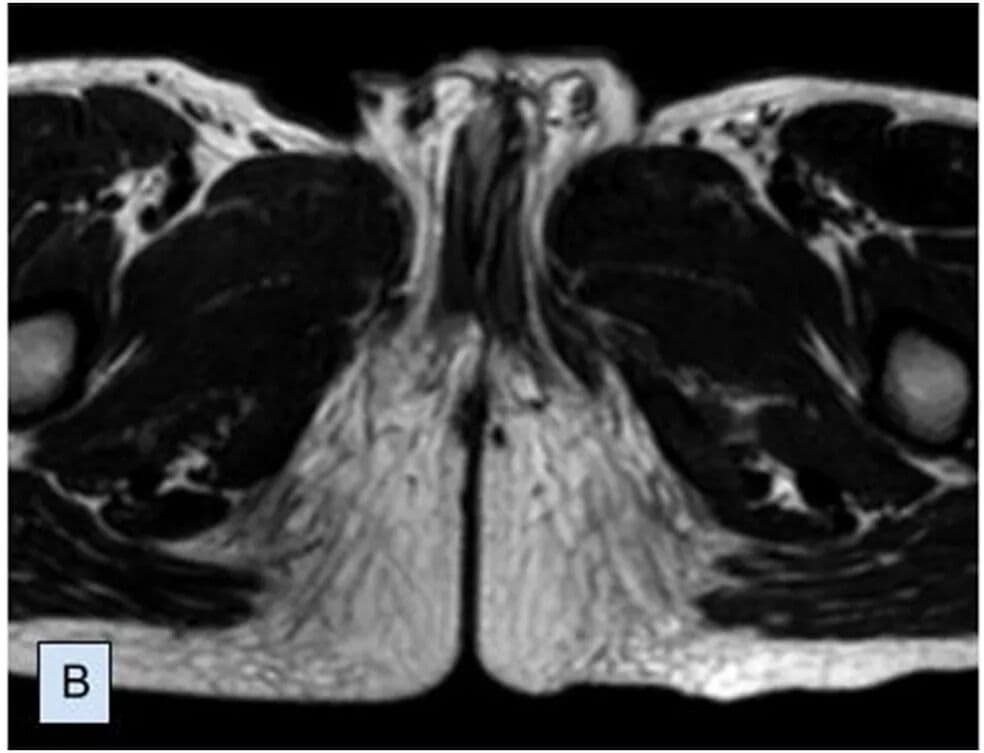 Em caso raríssimo, menino nasce com dois pênis e passa por cirurgia