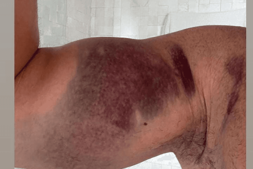 Deputado paraibano rompe tendão ao exceder carga em exercício e passa por cirurgia: "soldado abatido"