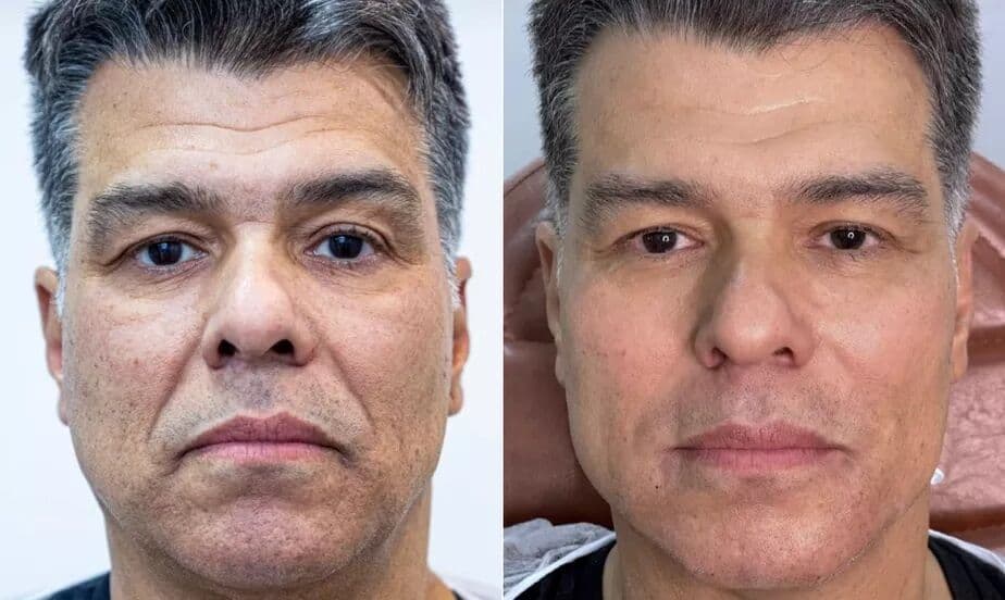 Maurício Mattar faz harmonização facial e mostra antes e depois