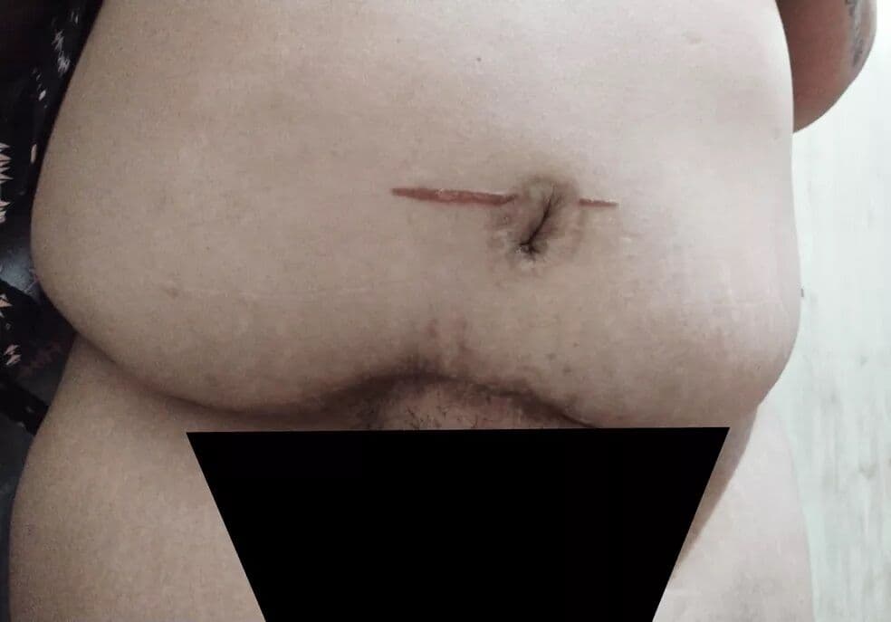 ‘Seio torto’, ‘sem umbigo’ e ‘peito mais alto do que o outro’: ex-pacientes de médico preso por cárcere privado mostram deformações após cirurgias