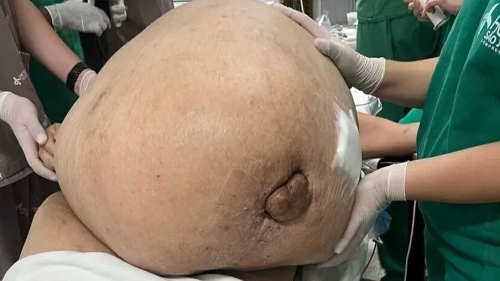 Tumor com cerca de 46 kg é retirado de mulher em cirurgia de emergência