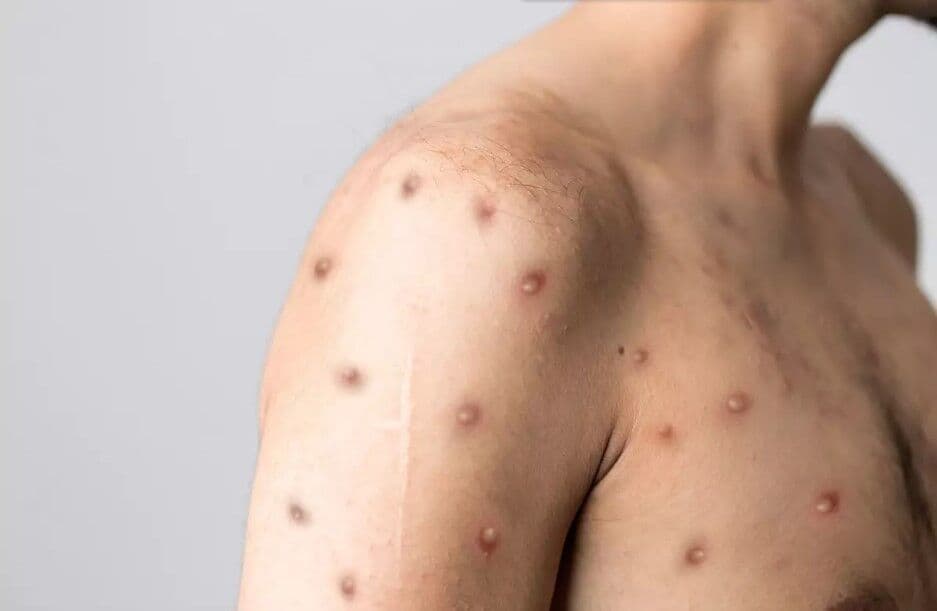 Paraíba tem 28 casos suspeitos e um confirmado de varíola dos macacos e Secretaria de Saúde alerta para prevenção