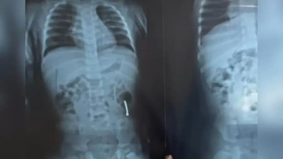 Menina de um ano é internada após engolir prego no dia do aniversário no Pará