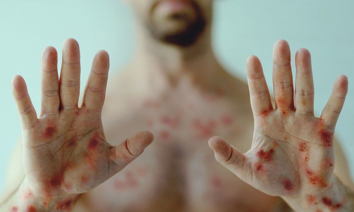 Varíola dos macacos: novo boletim confirma 29 casos da doença na Paraíba