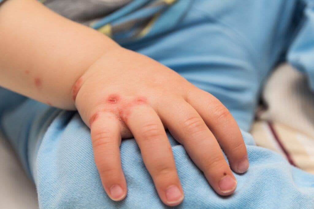 OMS muda nome, e varíola do macaco passa a ser chamada de 'mpox'