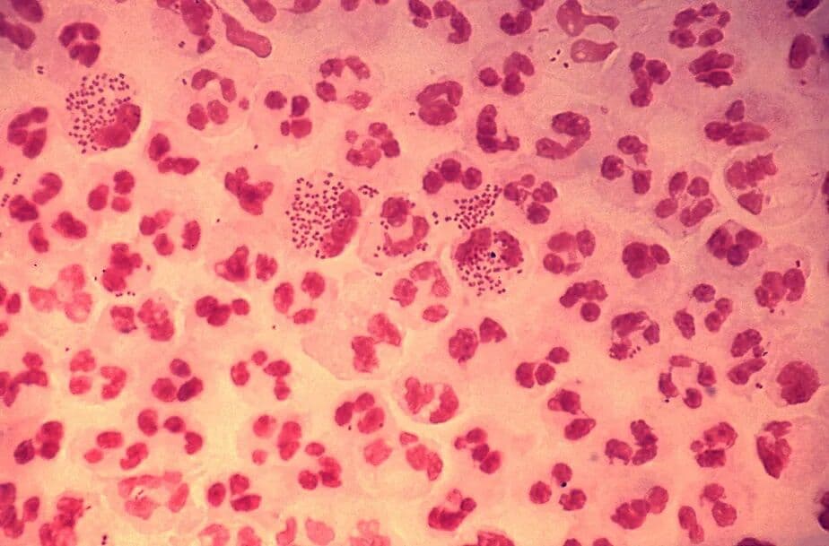 Supergonorreia: cientistas encontram cepa resistente a antibióticos nos EUA