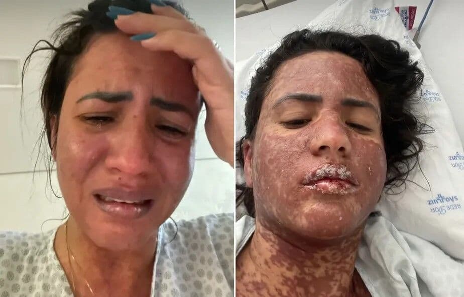 "Achei que ia morrer", diz esposa de Frank Aguiar após ser internada com 'doença que queima a pele'