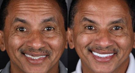 Cantor Manoel Gomes passa por transformação avaliada em R$ 70 mil