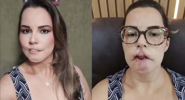 PMMA: os perigos do uso após caso de influencer perder parte do lábio