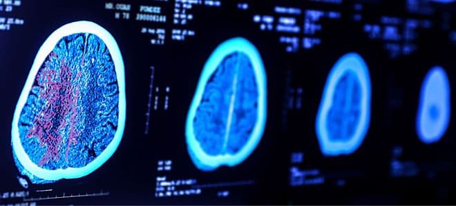 Maio Cinza alerta para câncer cerebral que tem alta taxa de mortalidade