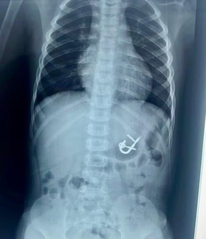 Criança de quatro anos é atendida em hospital após engolir cadeado com as chaves