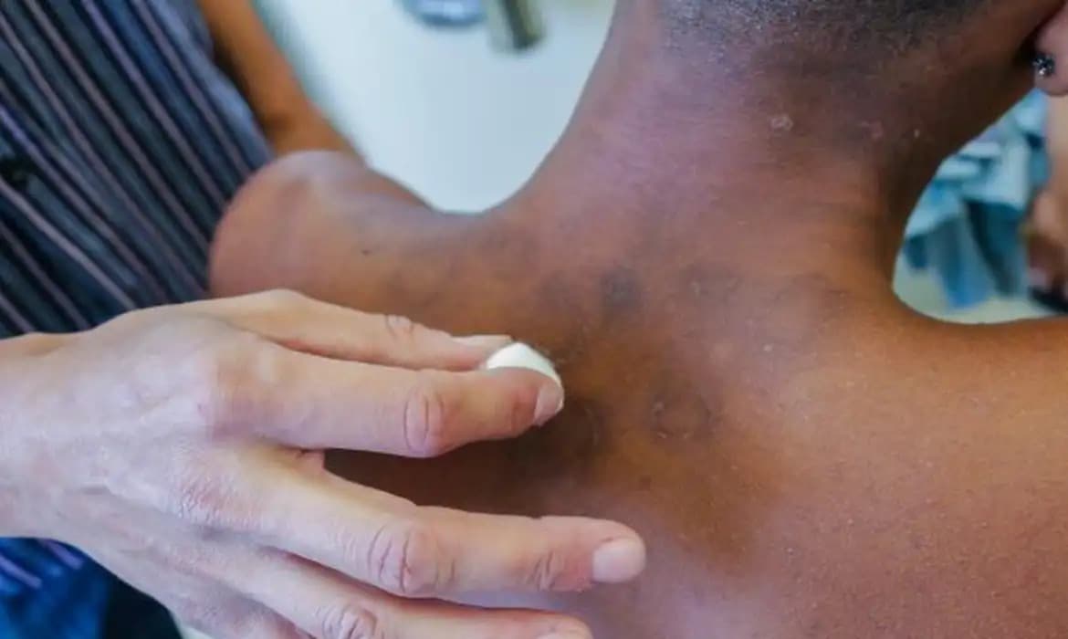 Inteligência Artificial criada por brasileiros avalia risco de agravamento da hanseníase