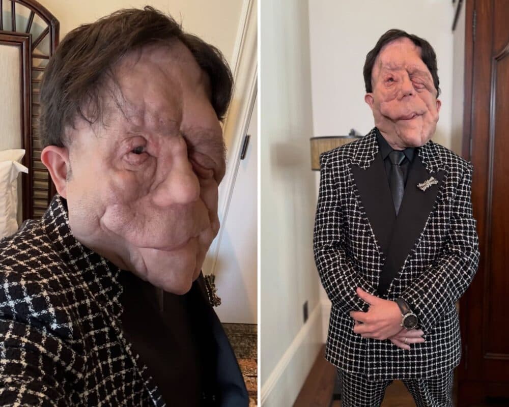Oscar 2026: A lição de humanidade de Adam Pearson e o impacto de 'Um Homem Diferente'