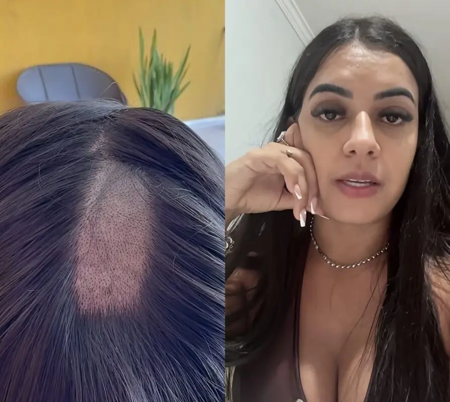 Laboratório Roseanne Dore demite funcionária que raspou em excesso cabelo de mulher durante exame na Paraíba